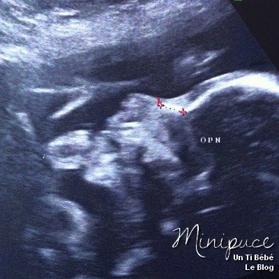echographie-nez-profil-bebe-23sa.jpg
